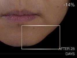 Gros plan du bas du visage avant le traitement, montrant des signes de relachement cutane et un manque de definition de l ovale du visage.
